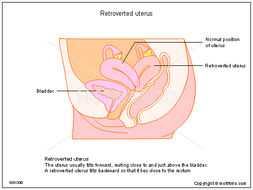 Tilted uterus info helpful positions orgasm